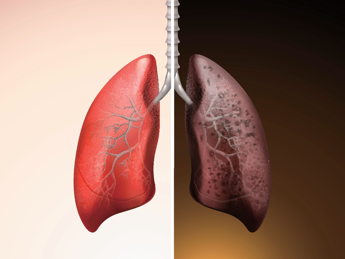 Ecco Come Diventano I Polmoni Di Un Fumatore Fondazione Umberto Veronesi Ecco Come Diventano I Polmoni Di Un Fumatore Fondazione Umberto Veronesi