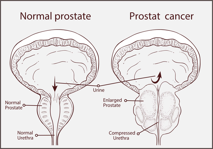 Hipertrofia Benigna de Prostata (HBP)