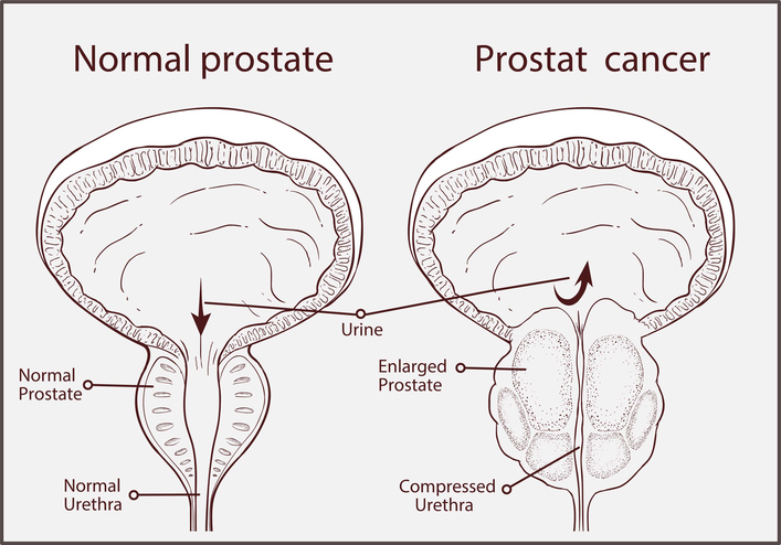 Ipertrofia prostatica benigna psa. Prosztatitis hozza ki