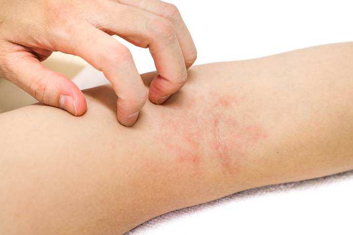 Esiste una relazione tra psoriasi e assunzione di nichel? | Fondazione  Umberto Veronesi