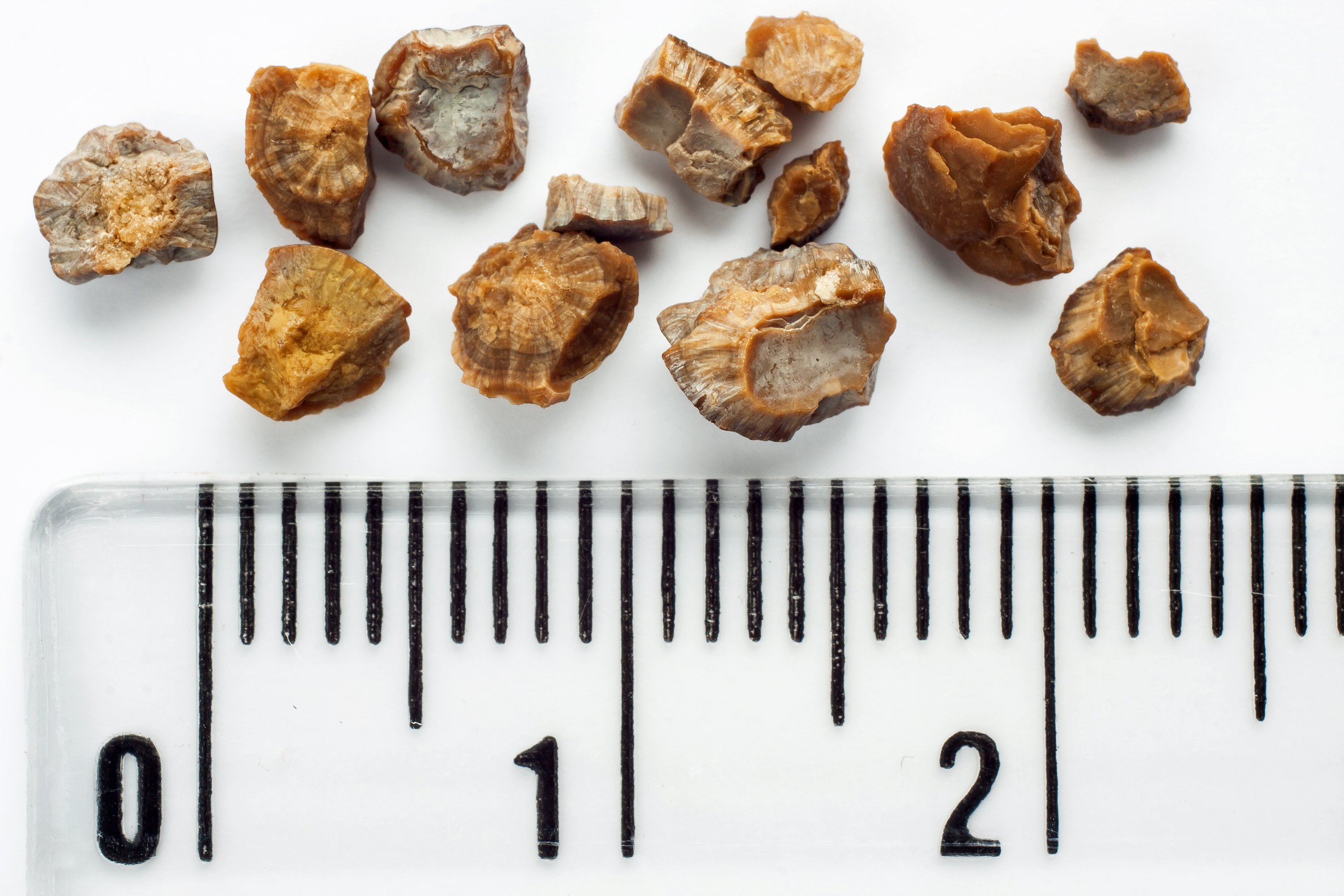 Calcoli Renali Si Possono Curare Anche Col Sesso Fondazione Umberto Veronesi