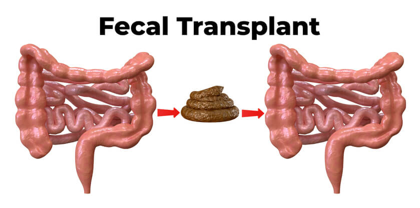 Trapianto Di Flora Intestinale Contro Un infezione Fondazione Umberto 