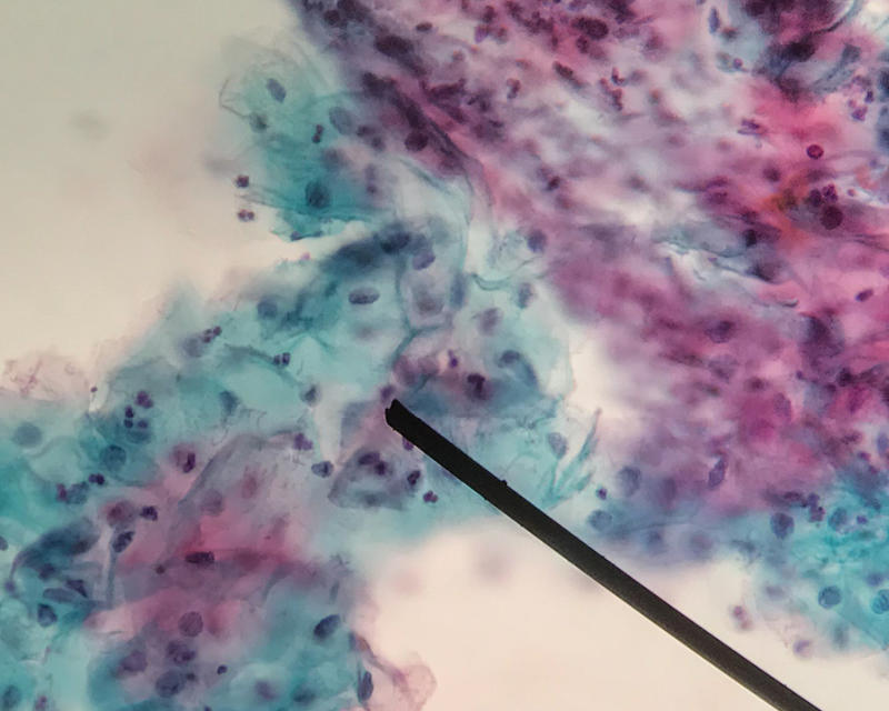 Papillomavirus quanto dura, Virus hpv quanto dura
