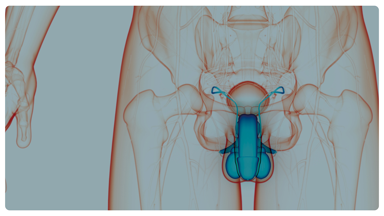 Ipertrofia prostatica benigna: il nemico è l'infiammazione