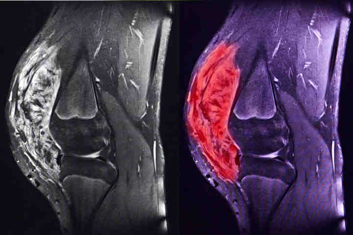 Sarcomi, la chemioterapia aumenta la sopravvivenza