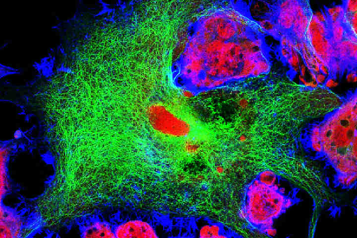 Neuroblastoma