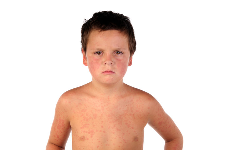 Morbillo, è allerta in Campania