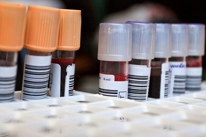 Tumore dell’ovaio: test genetici e biopsia liquida per scoprirlo in tempo 