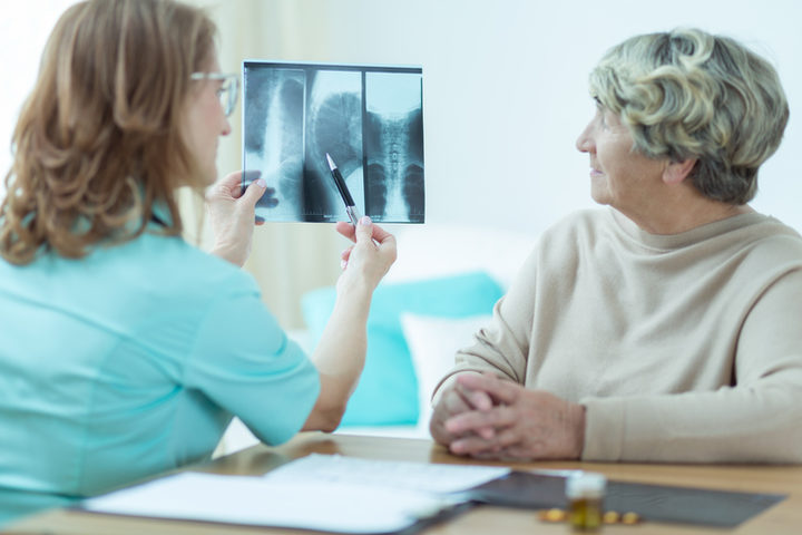 Ossa a rischio per le donne con  il tumore al seno in terapia adiuvante