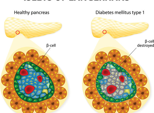 A che cosa serve il trapianto delle isole pancreatiche?