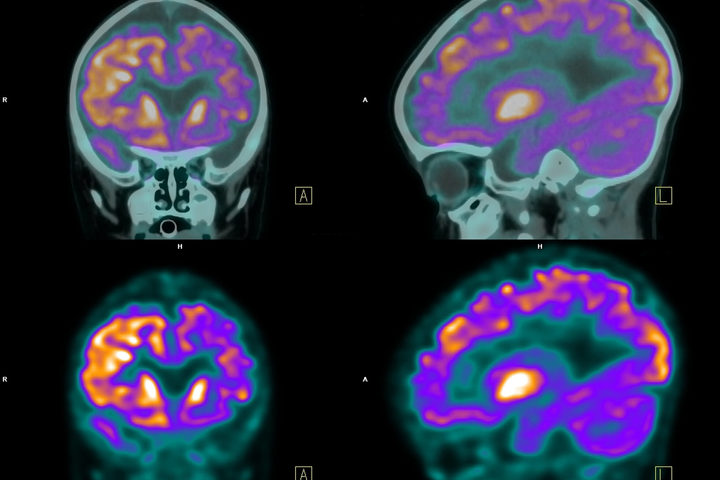 Così l'epilessia diventa cronica