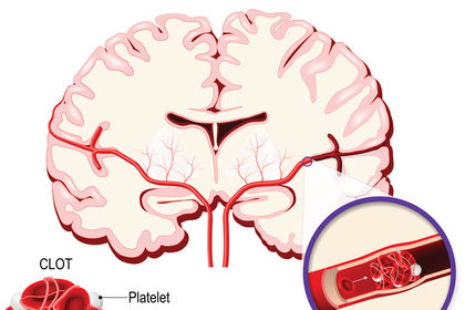 I cinque campanelli d’allarme dell’ictus cerebrale