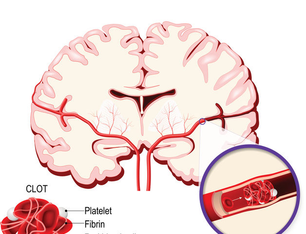 I cinque campanelli d’allarme dell’ictus cerebrale