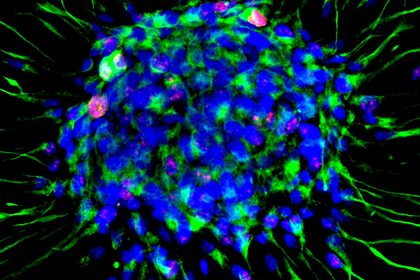 Dalle staminali neurali una cura per la sclerosi multipla?