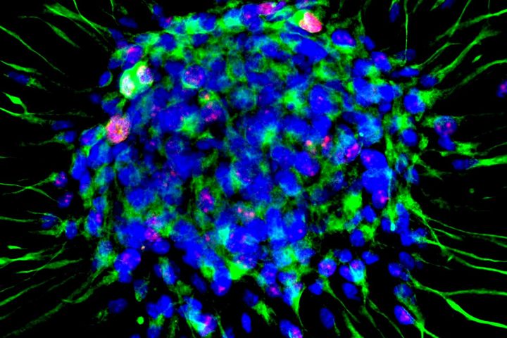 Dalle staminali neurali una cura per la sclerosi multipla?