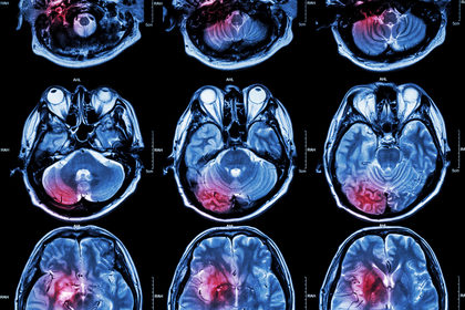 L'ictus si può curare sempre più efficacemente grazie alla chirurgia endovascolare