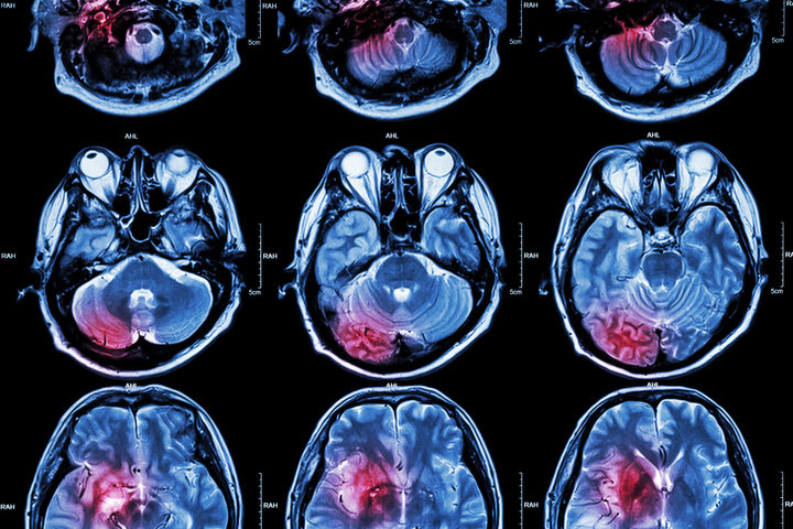 L'ictus si può curare sempre più efficacemente grazie alla chirurgia endovascolare