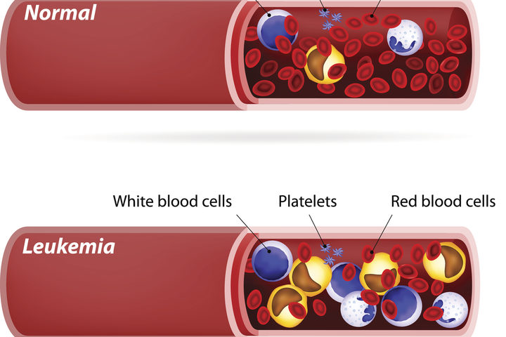 Leucemia mieloide acuta