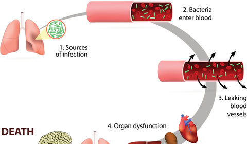 Il vademecum degli anestesisti italiani per conoscere la sepsi