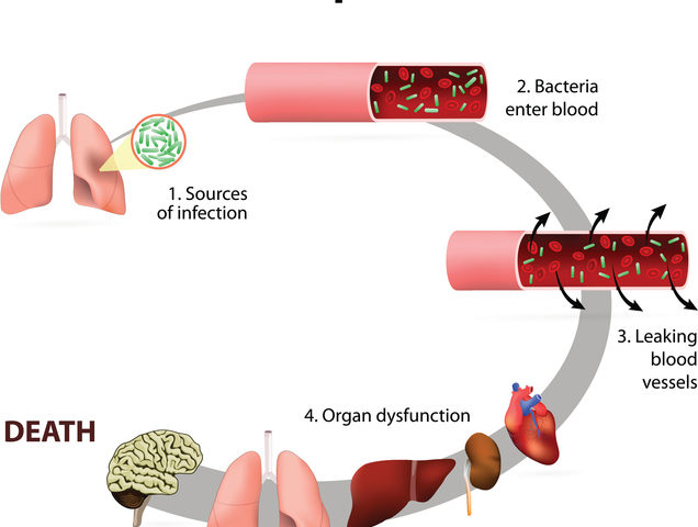 Il vademecum degli anestesisti italiani per conoscere la sepsi
