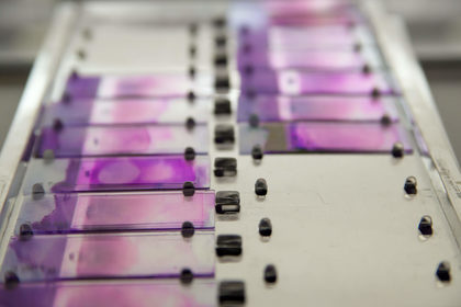 Tumori del sangue: i tempi stanno cambiando