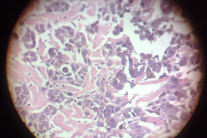 Osteosarcoma