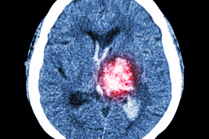 Emorragia cerebrale: i sintomi a cui prestare attenzione