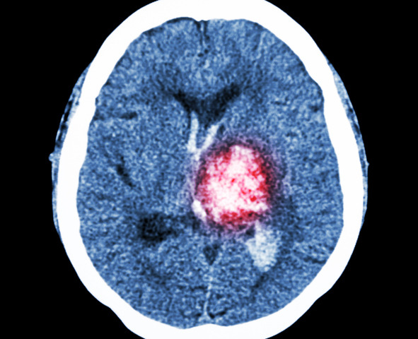 Emorragia cerebrale: i sintomi a cui prestare attenzione