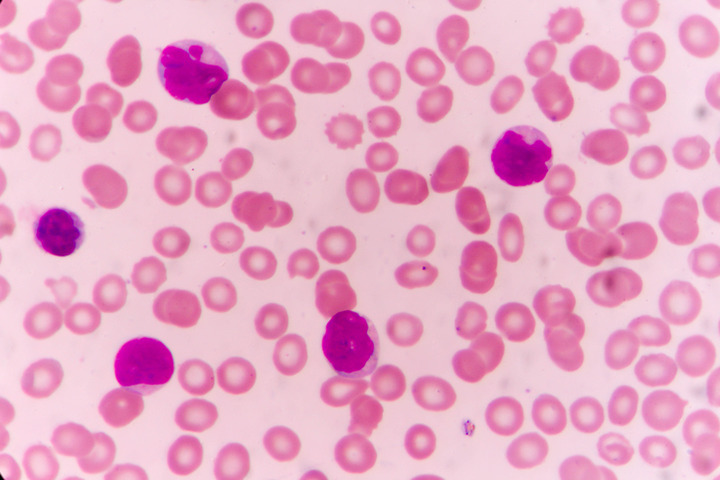 Leucemia mieloide cronica