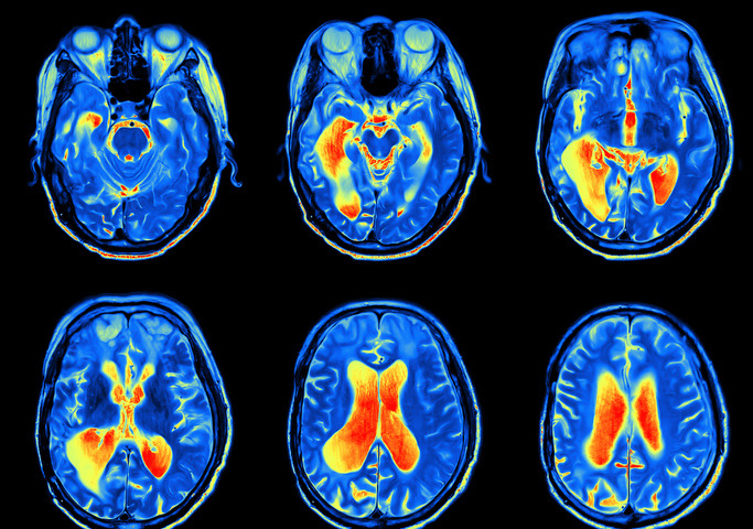 Medulloblastoma