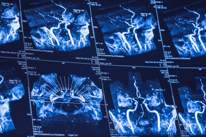 Ictus: recupero migliore se il cervello viene messo a «riposo»
