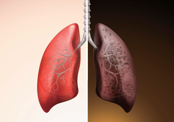 Ecco come diventano i polmoni di un fumatore