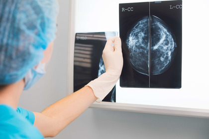 Tumore seno: un test genetico per capire quando la chemioterapia non serve