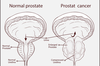 Come curare l'ipertrofia prostatica benigna?