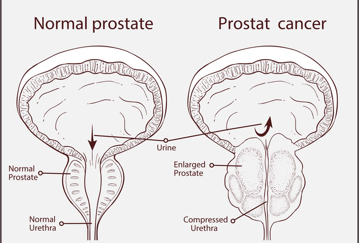 ipertrofia prostatica benigna A prosztatitis közel van