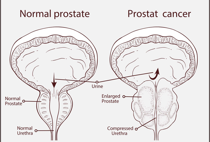 ipertrofia prostatica