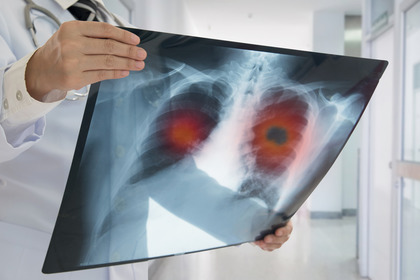 Tumore del polmone: l'immunoterapia diventa la prima scelta 