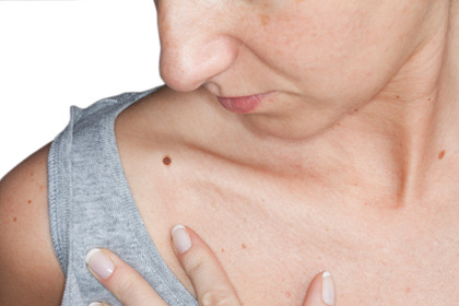 Melanoma: come riconoscere un neo sospetto?