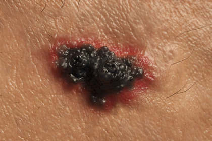Come viene diagnosticato il melanoma metastatico?