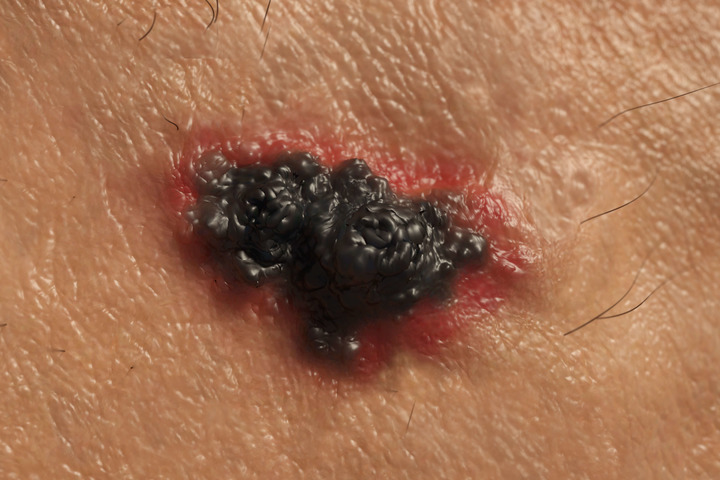 Come viene diagnosticato il melanoma metastatico?