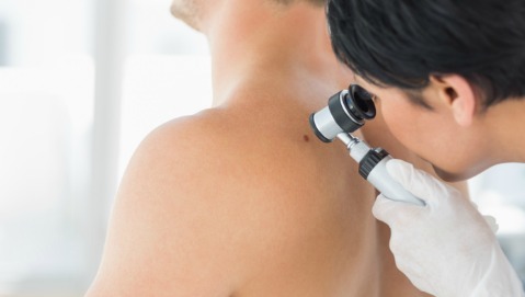 Non è il numero dei nei a misurare il rischio di melanoma