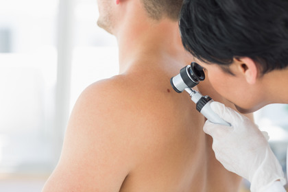 Melanoma più lontano se si usa (correttamente) la crema solare 