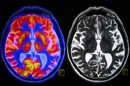 La solitudine modifica il cervello