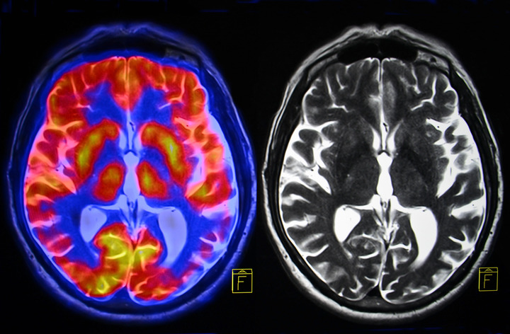 La solitudine modifica il cervello