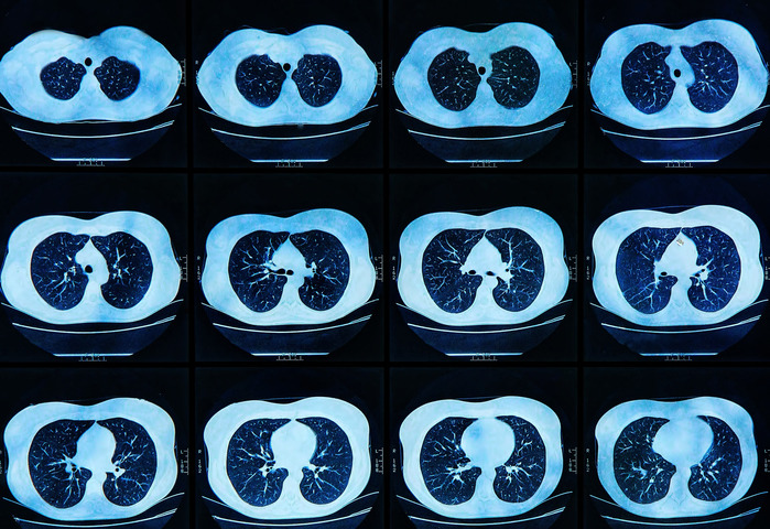 Tumore del polmone: lo screening (Tac spirale) riduce la mortalità