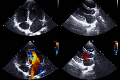 Infarto: un microRNA per rigenerare il cuore