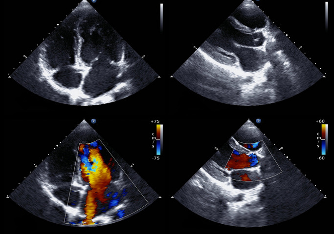 Infarto: un microRNA per rigenerare il cuore