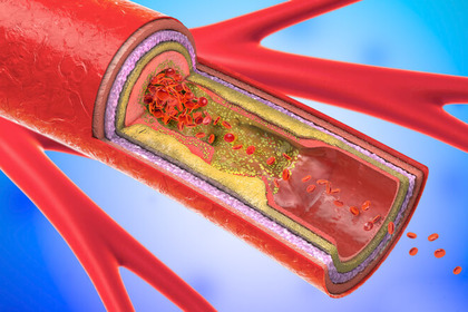 Carotidi ostruite: quando è necessario intervenire?