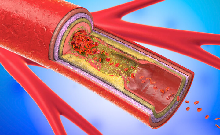 Carotidi ostruite: quando è necessario intervenire?