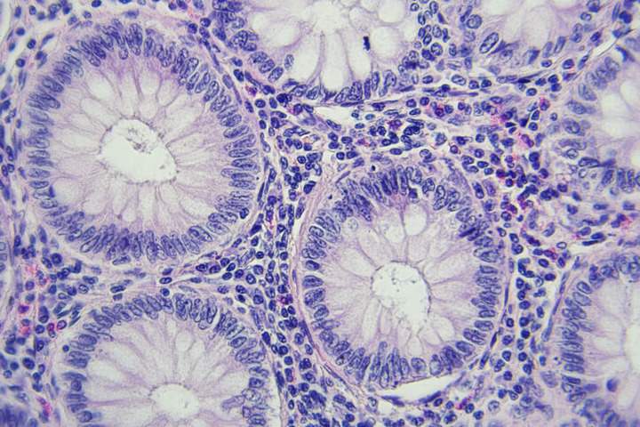 Tumore del colon-retto: attenzione alle metastasi «precoci»